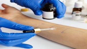 Kene ısırığına dikkat! Kırmızı et alerjisi yapabiliyor!