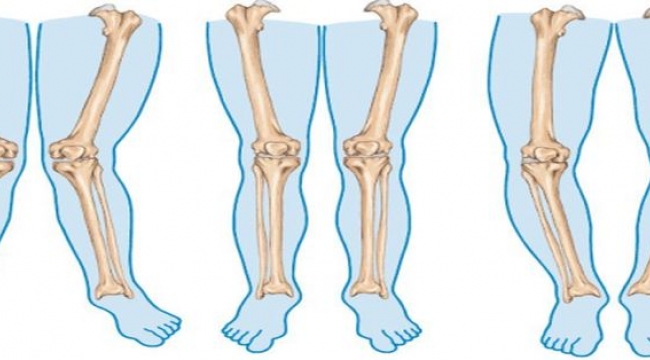 Çocuklarda bacak eğriliğinin en sık nedeni "Raşitizm"