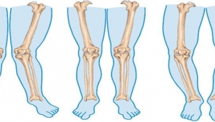 Çocuklarda bacak eğriliğinin en sık nedeni "Raşitizm"